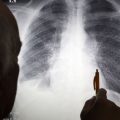 Постійна втома та стукіт в пальцях: симптоми раку легень, які люди ігнорують